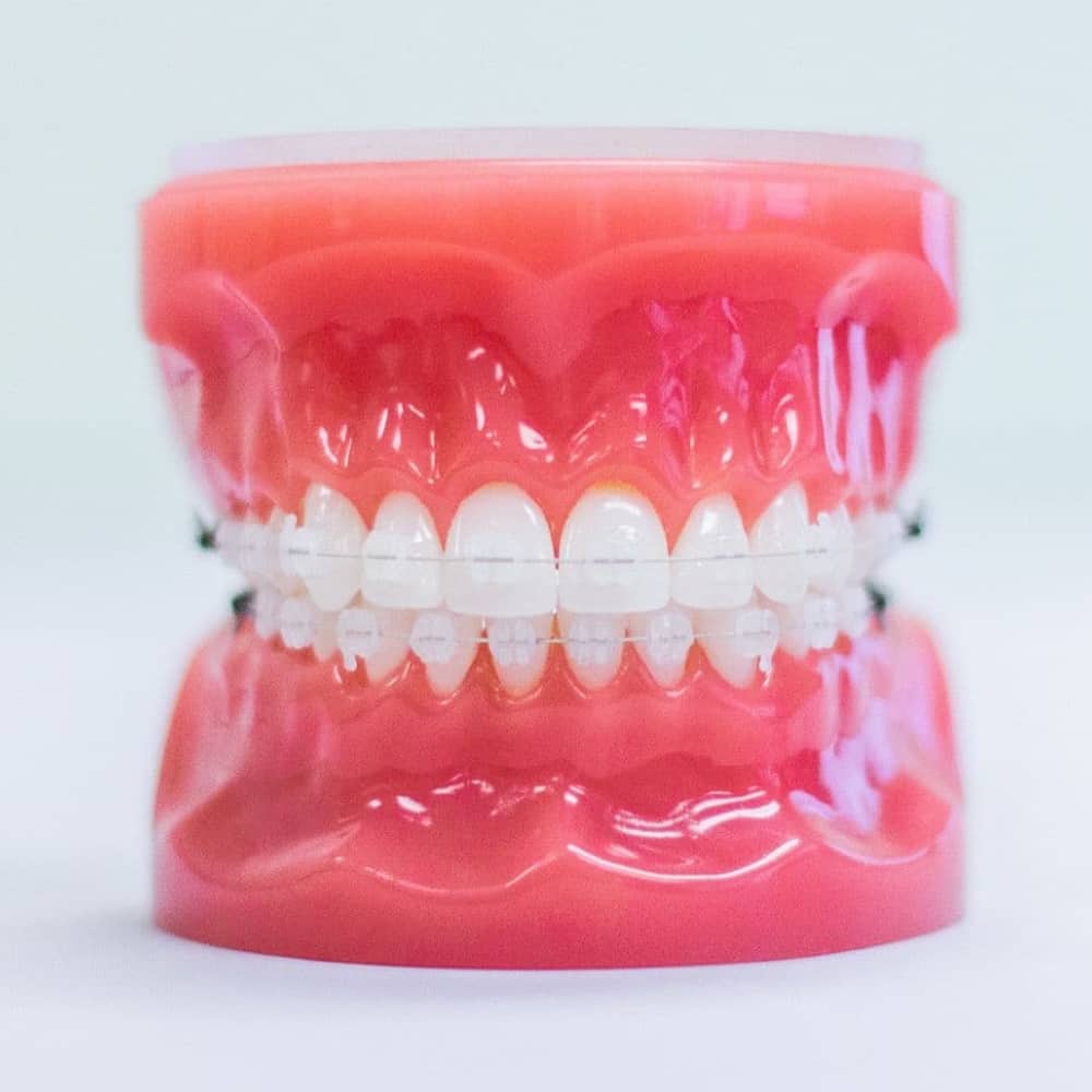 invisalign aligners on model