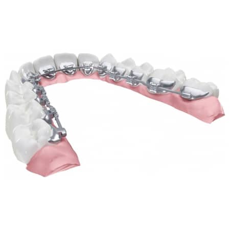 invisalign aligners on model