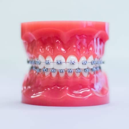 invisalign aligners on model