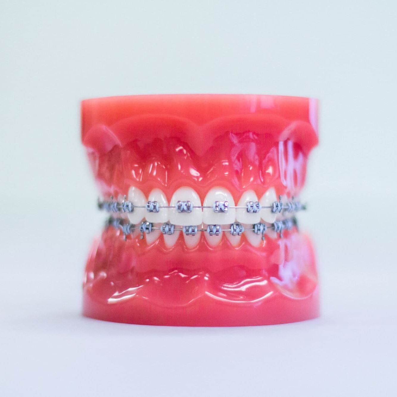 Model of teeth with metal braces, highlighting orthodontic treatment options at Luv Braces, an Austin orthodontist.