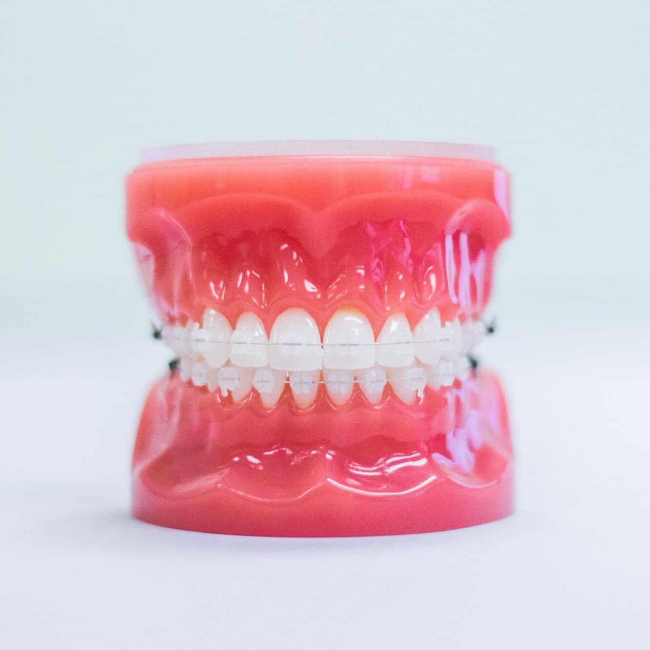 Model of teeth with clear braces, illustrating orthodontics in Austin and options like Invisalign at Luv Braces.